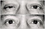 Right eye drooping of eyelid before and after surgery