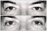 Sagging eyelids before and after surgery